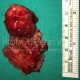 Salivary Gland Pleomorphic Adenoma Surgery - Prof. Cetin Vural, M.D. - Istanbul