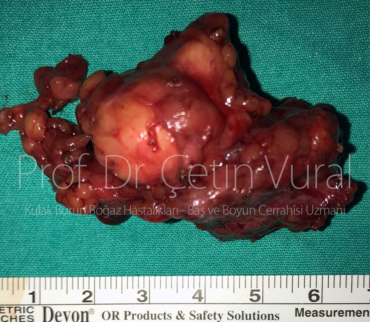 Pleomorphic Adenoma Surgery in Istanbul - Prof. Cetin Vural, M.D.