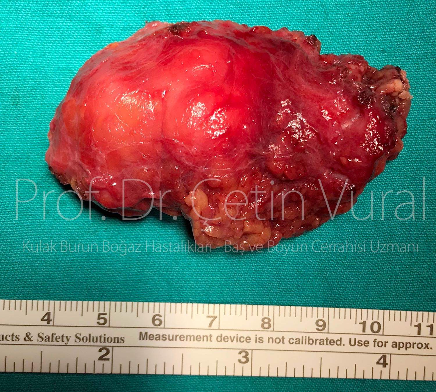 Salivary Gland Pleomorphic Adenoma Surgery - Prof. Cetin Vural, M.D. - Istanbul