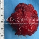 Salivary Gland Pleomorphic Adenoma Surgery - Prof. Cetin Vural, M.D. - Istanbul