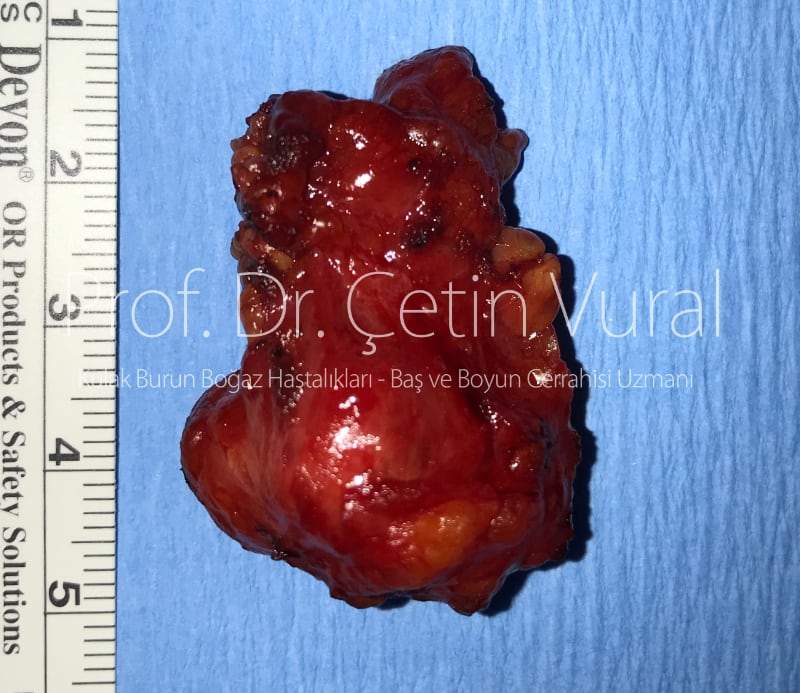 Parotid Tumor Surgery in Istanbul - Prof. Cetin Vural, M.D.