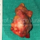 Parotid Tumor Surgery in Istanbul - Prof. Cetin Vural, M.D.