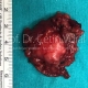 Parotid Tumor Surgery in Istanbul - Prof. Cetin Vural, M.D.