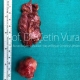 Parotid Tumor Surgery in Istanbul - Prof. Cetin Vural, M.D.
