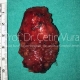 Parotid Tumor Surgery in Istanbul - Prof. Cetin Vural, M.D.