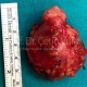 Parotid Tumor Surgery in Istanbul - Prof. Cetin Vural, M.D.