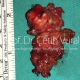Parotid Tumor Surgery in Istanbul - Prof. Cetin Vural, M.D.