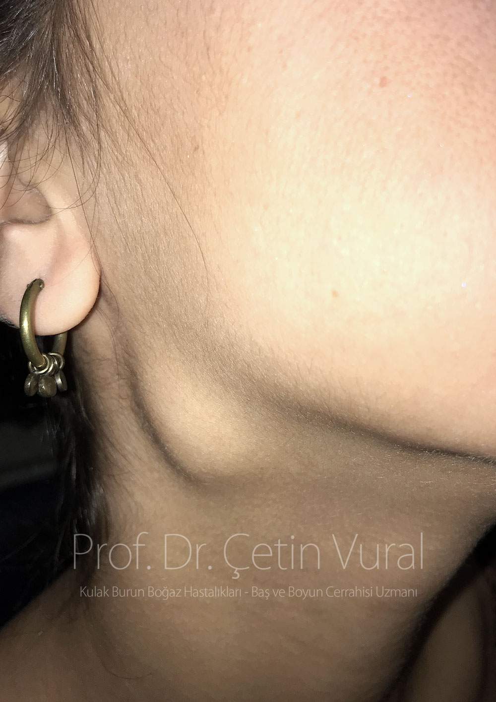 Parotid Tumor - Prof. Cetin Vural, M.D.