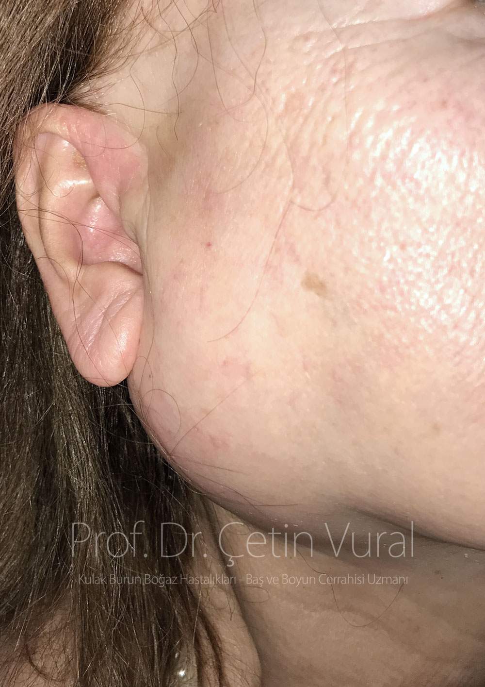 Parotid Tumor - Prof. Cetin Vural, M.D.